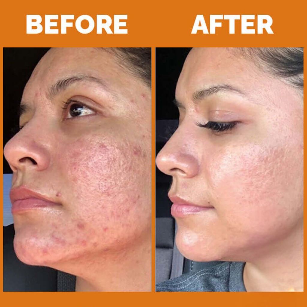 Teashell Niacinamide Serum before and after results
